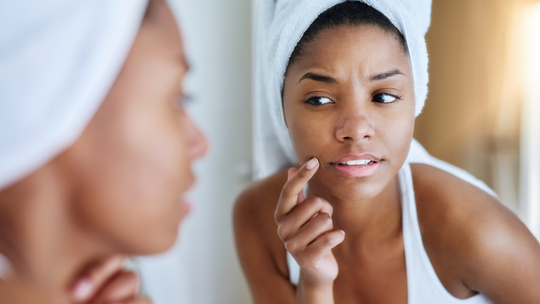 Why Am I Experiencing Skin Purging With New Products & What Can I Do About It?