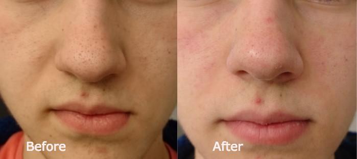 kalmeren zout Glans Blackhead Removal Mask – salisskincare