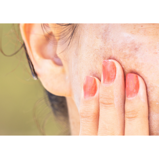 4 Remedies For Pigmentation