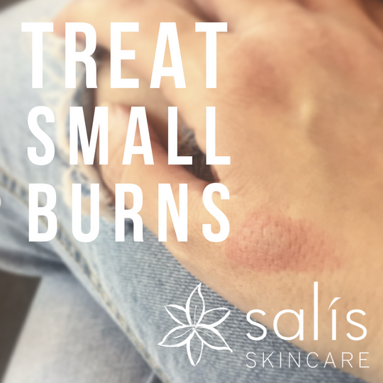 How to use Salis products to treat Small Burns