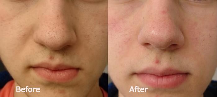 Before and After with the Blackhead Removal Mask
